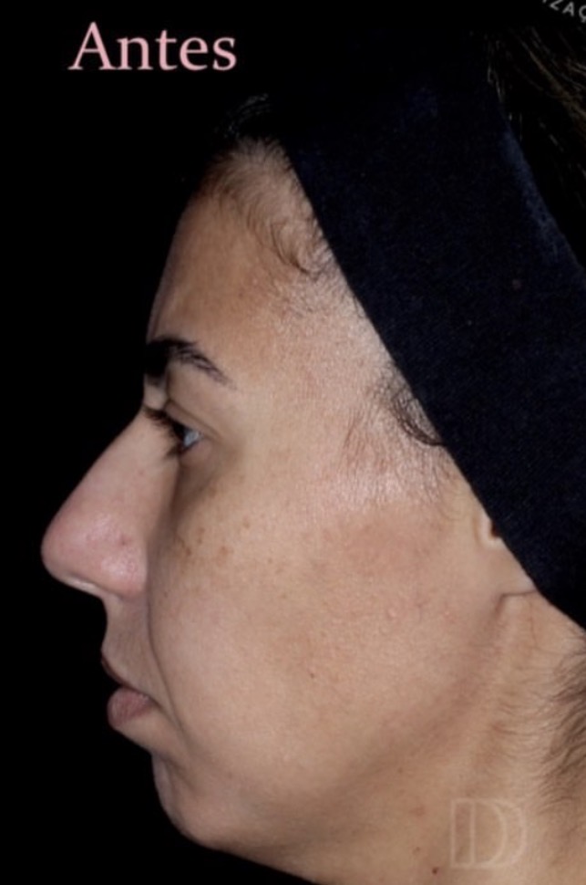 Antes — Harmonização Facial (perfiloplastia)