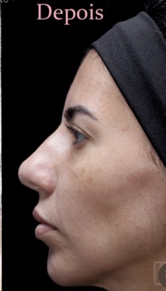Depois — Harmonização Facial (perfiloplastia)