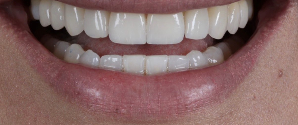 Depois — Lentes de contato dental
