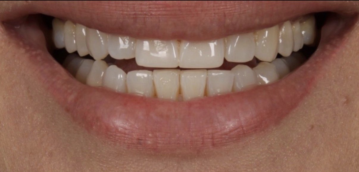 Antes — Lentes de contato dental
