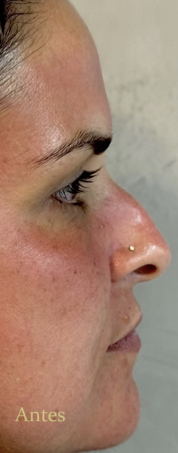 Antes — Harmonização Facial (Rinomodelação)