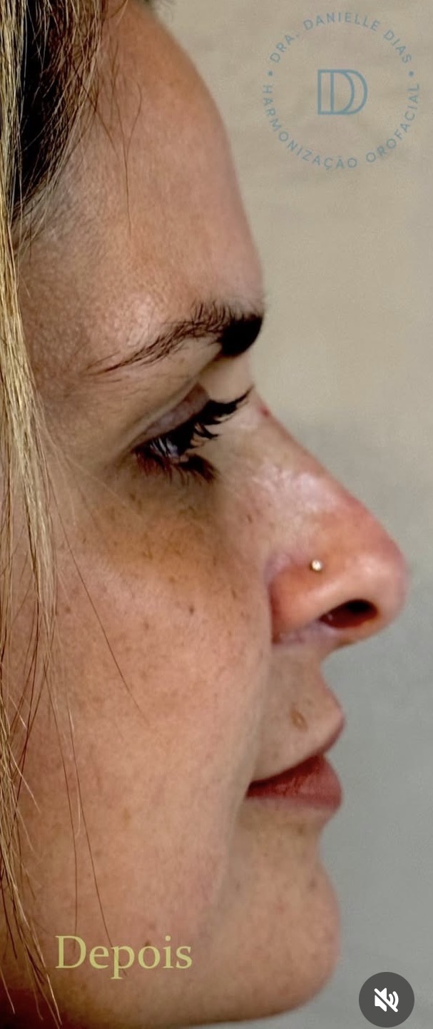 Depois — Harmonização Facial (Rinomodelação)
