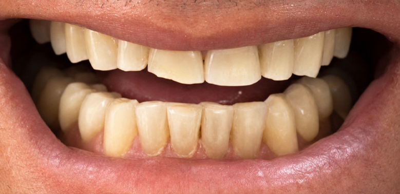 Antes — Lentes de contato dental