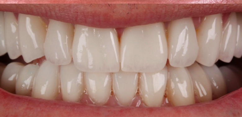 Depois — Lentes de contato dental