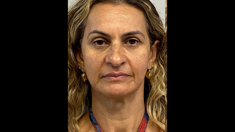 Antes — Harmonização Facial (Full Face)