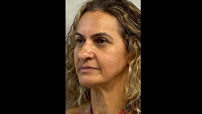 Antes — Harmonização Facial (Full Face)