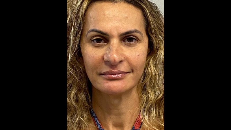 Depois — Harmonização Facial (Full Face)