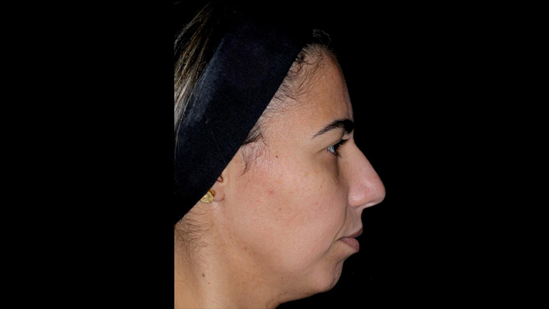Antes — Harmonização Facial (perfiloplastia)