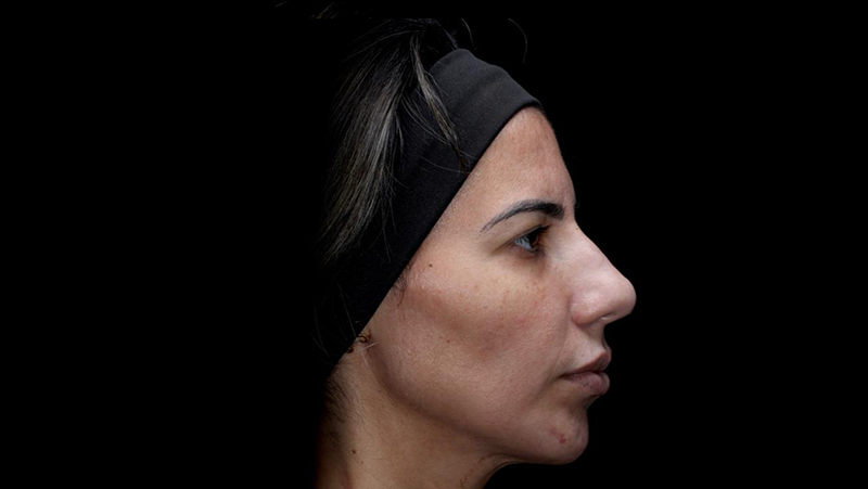 Depois — Harmonização Facial (perfiloplastia)